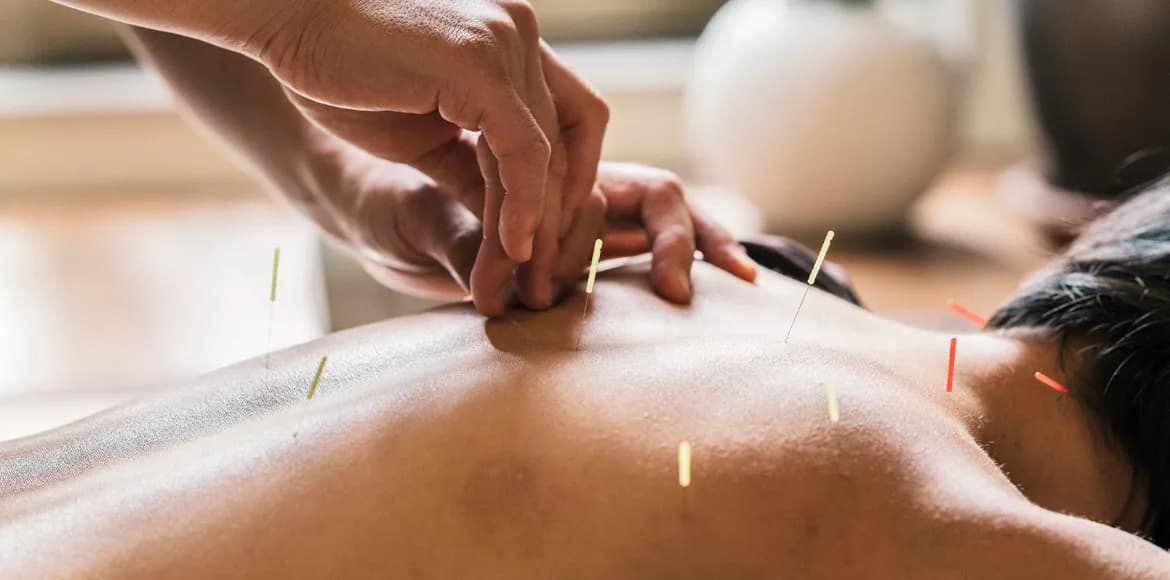 O que é acupuntura e quais são os benefícios para a saúde